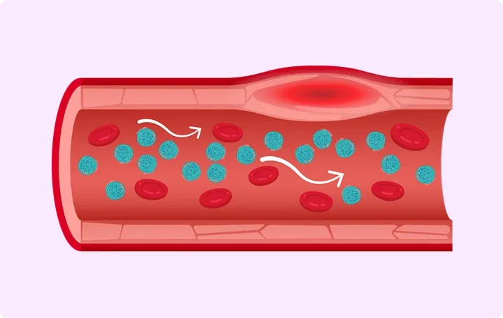Illustration of how high levels of chylomicrons are thought to restrict blood flow and induce inflammation in blood vessels.