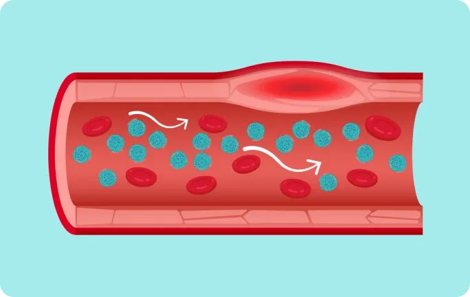 Illustration of how high levels of chylomicrons are thought to restrict blood flow and induce inflammation in blood vessels.