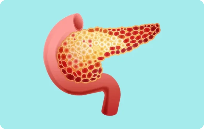 Illustration of how the pancreas may be vulnerable to ischaemic damage caused by high levels of chylomicrons.