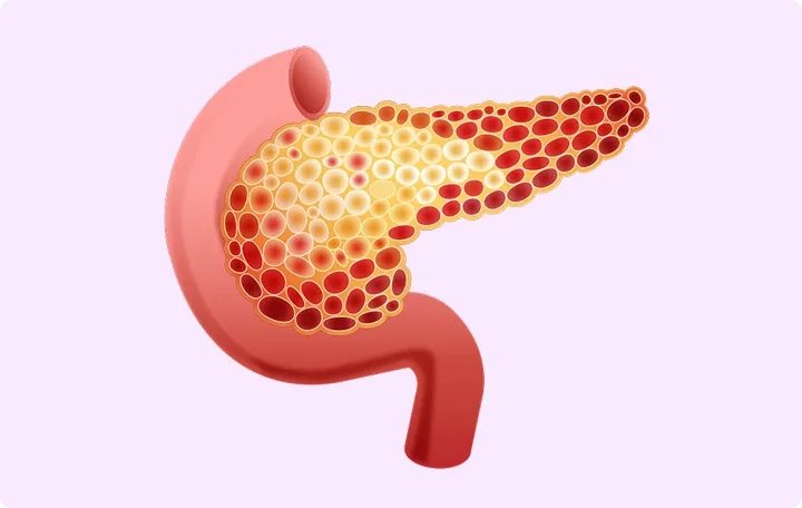 Illustration of how the pancreas may be vulnerable to ischaemic damage caused by high levels of chylomicrons.